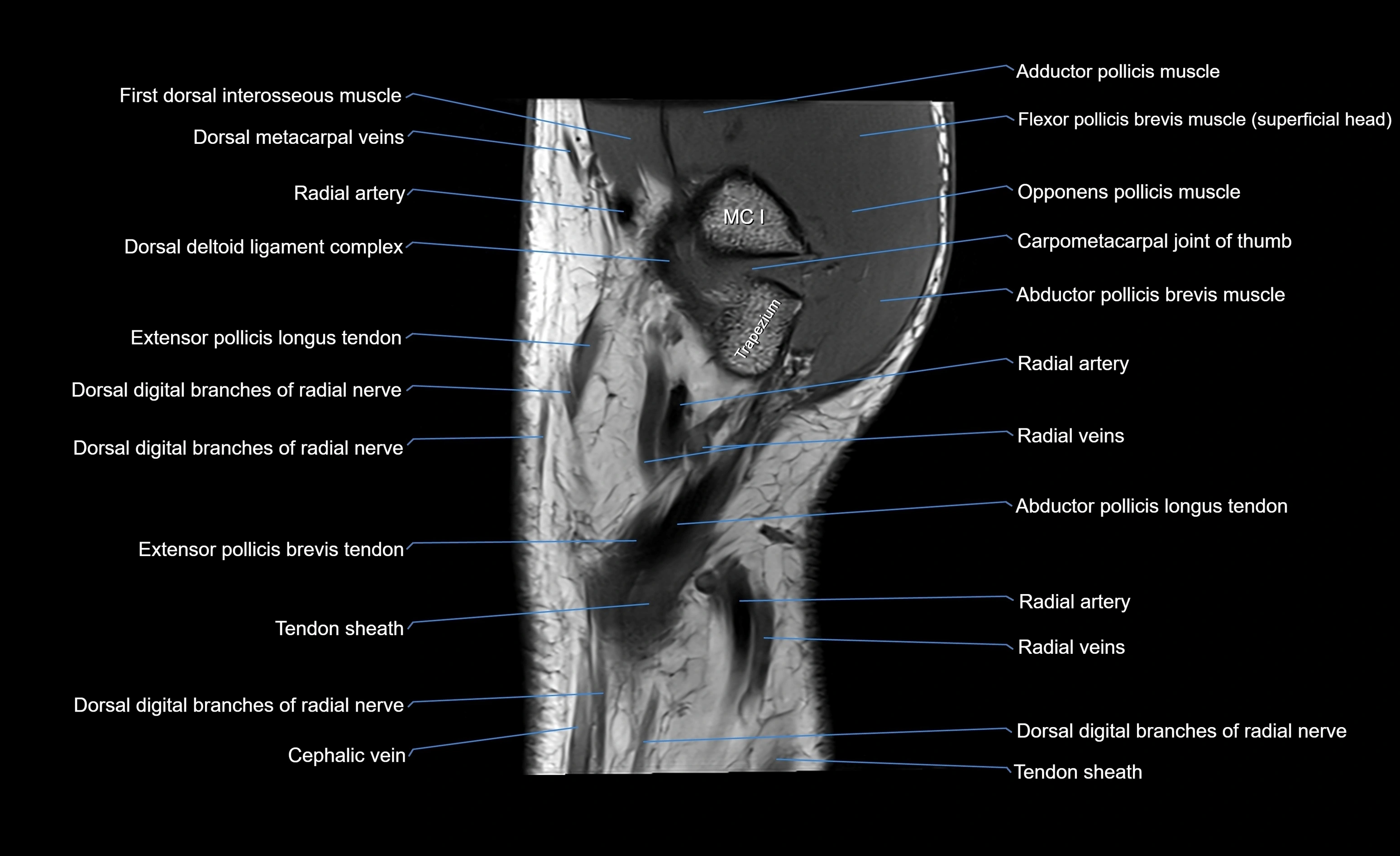 MRI wrist sagittal cross sectional anatomy 3T  radiology  image-img-00001-00004.webp